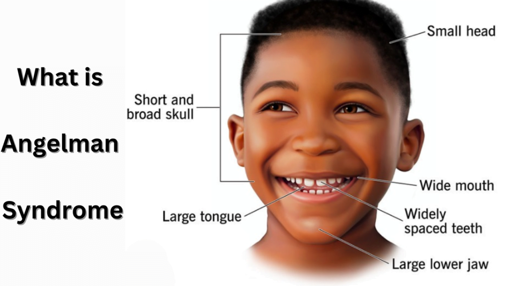 What is Angelman Syndrome; a rare neuro-genetic disorder